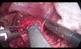 Cardiomiotomía laparoscópica de Heller con fundoplicatura de Dor 