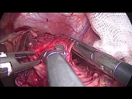 Cardiomiotomía laparoscópica de Heller con fundoplicatura de Dor 