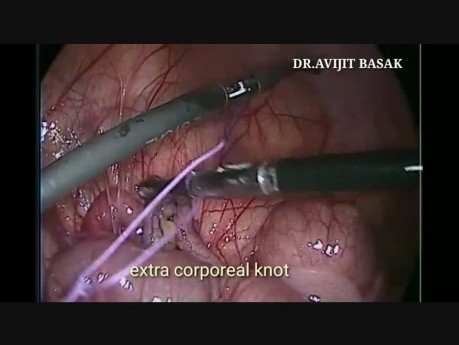 Apendicectomía laparoscópica en el embarazo