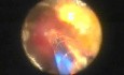 Bleeding Control With Greenlight HPS