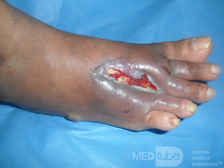Úlcera del pie diabético con osteomielitis