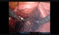 Prostatectomía robótica con preservación del espacio de Retzius