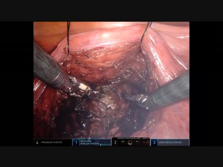 Prostatectomía robótica con preservación del espacio de Retzius