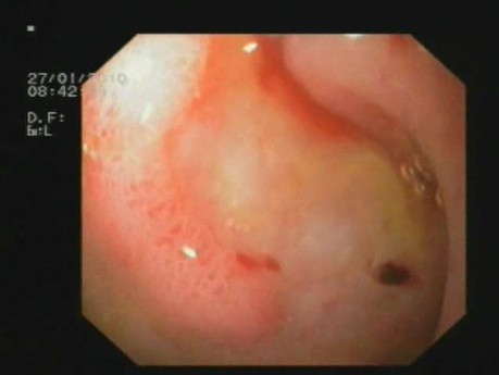 Ulceración duodenal - sangrado gastrointestinal