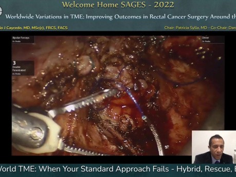 Escisión mesorrectal total en el mundo real cuando su enfoque estándar falla: híbrido, rescate, ayuda