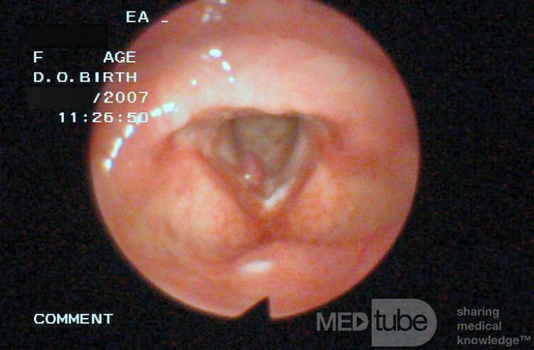 Pólipo de cuerda vocal