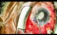 Intercambio de Lente Intraocular (LIO) dislocada con fijación Yamane, Parte 2