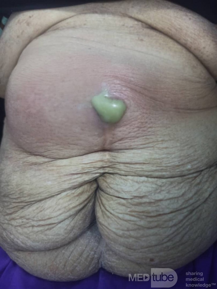 Absceso de la pared abdominal