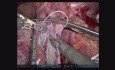 Trasplante robótico de hígado de donante fallecido