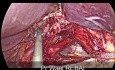 Válvula antirreflujo posterior tipo TOUPET