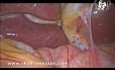 La anatomía del surco de Rouviere vista durante la colecistectomía laparoscópica