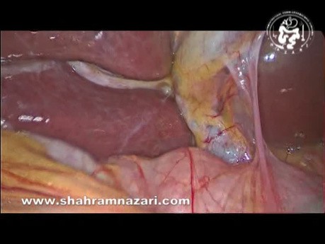 La anatomía del surco de Rouviere vista durante la colecistectomía laparoscópica
