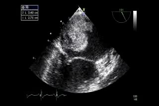 Mixoma en encocardio