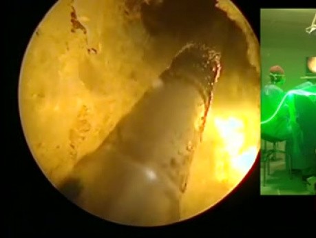 Cirugía con láser verde para el agrandamiento de la próstata