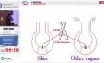 Fibrosis quística