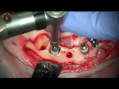 Extracción de implantes dentales e inserción de implantes inmediatos combinados con regeneración ósea guiada