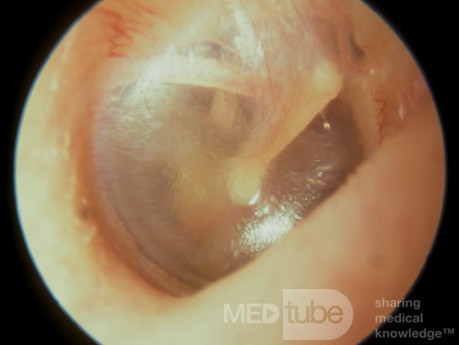 Membrana timpánica normal que muestra la cuerda del tímpano