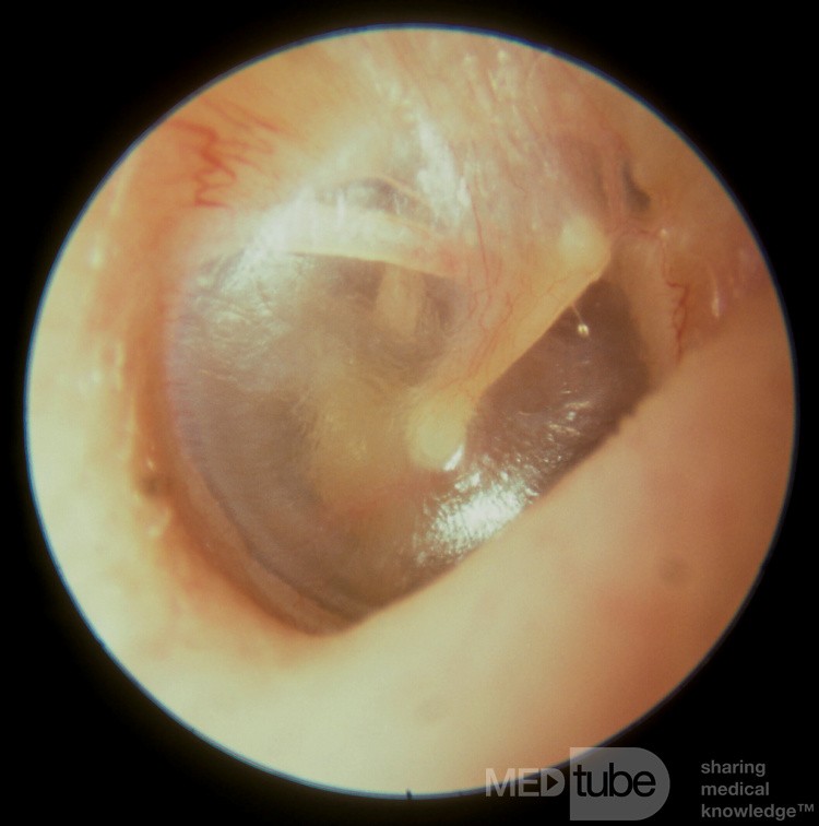 Membrana timpánica normal que muestra la cuerda del tímpano