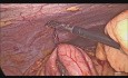 Resección laparoscópica de un tumor neuroendocrino del íleon