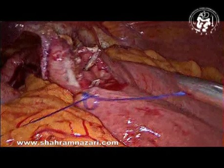 Gastrectomía distal D1 LND