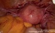 Operacja raka endometrium – węzeł wartowniczy
