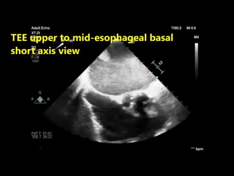 Ecocardiografía transesofágica    