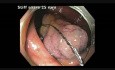 Complicaciones de la resección mucosa endoscópica (RME) - sangrado del ciego - video B
