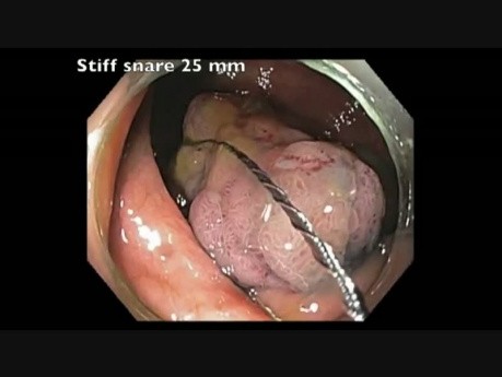 Complicaciones de la resección mucosa endoscópica (RME) - sangrado del ciego - video B