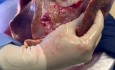 Edema pulmonar inducido por perfusión pulmonar ex vivo en pacientes con endocarditis de la válvula tricúspide