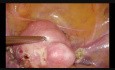 Histerectomía ambulatoria - caso simple, disección de la arteria uterina