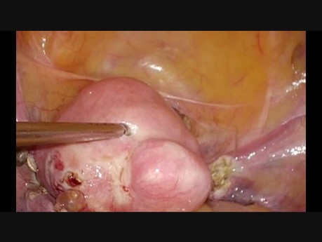 Histerectomía ambulatoria - caso simple, disección de la arteria uterina