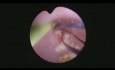 Litotricia ureteroscópica semirrígida en niños