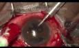 Una contusión de globo cerrado descuidada manejada con lente Scleral Tuck