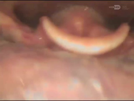 Laringoscopia