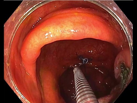 Método de tracción en  tumores de extensión lateral de colon derecho
