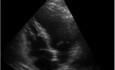Anomalía del movimiento de la pared apical del ventrículo izquierdo, infarto de miocardio anterior
