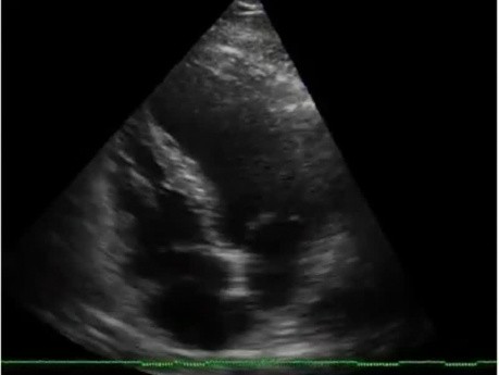 Anomalía del movimiento de la pared apical del ventrículo izquierdo, infarto de miocardio anterior