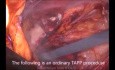 Tratamiento laparoscópico de la hernia inguinal estrangulada