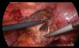 Neoureterocistostomía transvesical laparoscópica
