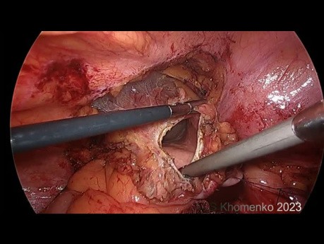 Neoureterocistostomía transvesical laparoscópica