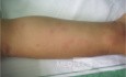 Urticaria