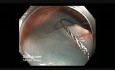 Canal de colonoscopia - rotación del endoscopio antes de RME de una lesión plana