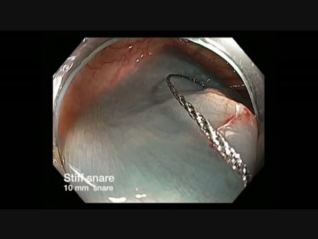 Canal de colonoscopia - rotación del endoscopio antes de RME de una lesión plana