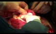 Miomectomía. Extirpación de grandes miomas con recorte temporal de las arterias uterinas