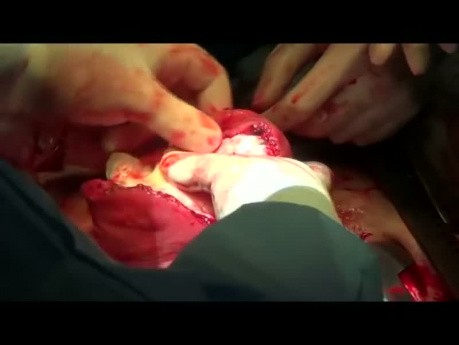 Miomectomía. Extirpación de grandes miomas con recorte temporal de las arterias uterinas