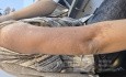 Nevus de Becker (Melanosis de Becker)