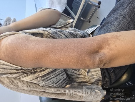 Nevus de Becker (Melanosis de Becker)