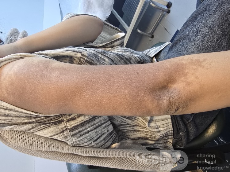 Nevus de Becker (Melanosis de Becker)