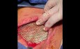 Chest Wall Reconstruction (2)