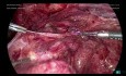 Extracción por enterólisis laparoscópica del hidrosalpinx izquierdo (parte 4)